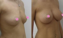 Фото до и после увеличения объёма груди анатомическими имплантатами