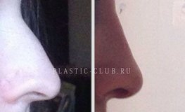 Фото до и после ринопластики