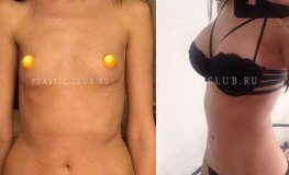 Фото до и после мамопластики имплантатами Allergan объемом 255 мл