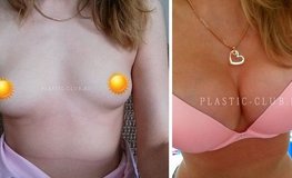 Фото до и после операции по увеличению груди круглыми имплантатами