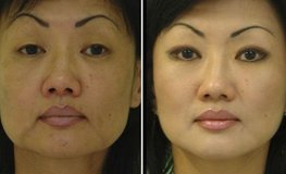 Фото до и после комплексной операции по омоложению лица