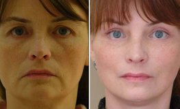 Фото до и после хирургического омоложения лица по личному методу врача