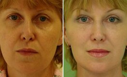 Фото до и после нескольких пластических операций по омоложению лица и шеи
