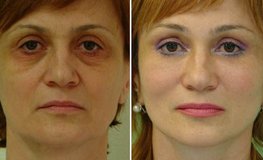 Фото до и после хирургического устранения выраженных возрастных изменений лица
