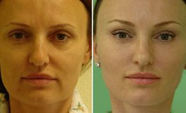 Фото до и после хирургического омоложения век и лица по личному методу хирурга