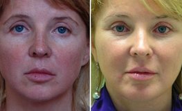 Фото до и после комплексной пластики лица по рекомендациям врача