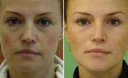 Фото до и после пластики средней зоны лица и грыжи нижних век