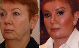 Фото до и после хирургического устранения выраженных возрастных изменений шеи и лица