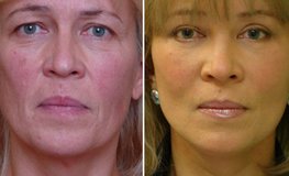 Фото до и после SMAS пластики, внутриротовой эндопластики средней зоны лица