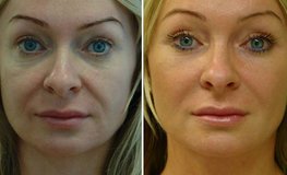 Фото до и после внутриротовой эндопластики средней зоны лица для омоложения