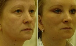 Фото до и после оперативного устранения возрастных изменений шеи и лица