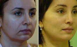 Фото до и после эндопластики средней зоны лица с подъемом углов рта