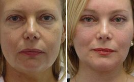 Фото до и после пластики лица, устранения гипоплазии подбородка