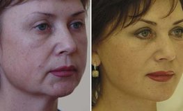 Фото до и после устранения возрастных изменений лица и гипоплазии подбородка