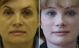 Фото до и после пластики век и лица, эндоскопически-вспомогательной пластики шеи