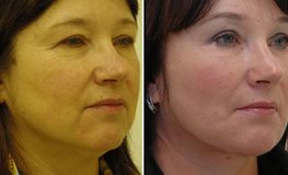 Фото до и после оперативного устранения возрастных изменений в области шеи и лица