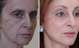 Фото до и после оперативного устранения “трупных глаз” и омоложения лица