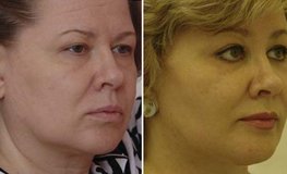 Фото до и после комплекса по хирургическому омоложению лица и шеи