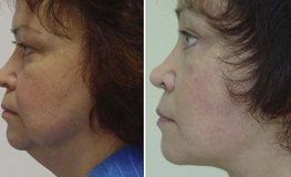 Фото до и после хирургического омоложения лица, подтяжка шеи, с комплексом операций