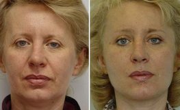 Фото до и после комплексных пластических операций по омоложению лица и шеи