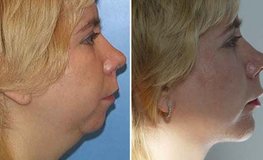 Фото до и после комплексных пластических операций по тотальному омоложению лица