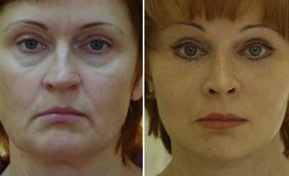 Фото до и после комплекса пластических операций по тотальному омоложению лица