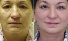 Фото до и после комплексной пластики по омоложению лица и шеи