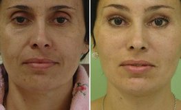Фото до и после нескольких операций по омоложению лица