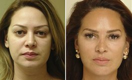 Фото до и после комплексного омоложения лица и шеи