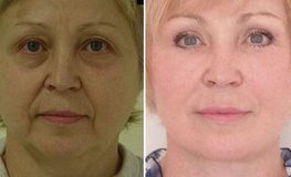 Фото до и после комплексного омоложения шеи и лица
