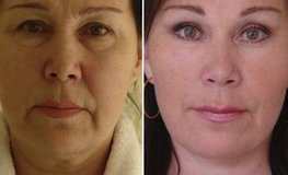 Фото до и после хирургических процедур по омоложения лица