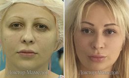 Фото до и после комплексного подхода к гармонизации лица