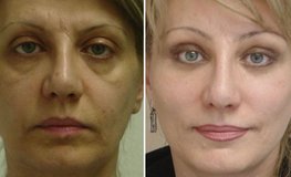 Фото до и после комплексного пластического омоложения лица