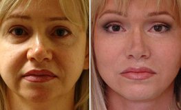 Фото до и после хирургического устранения возрастных изменений лица
