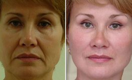 Фото до и после пластического устранения возрастных изменений лица
