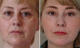 Фото до и после операции по омоложению лица и шеи