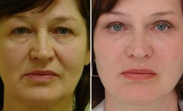 Фото до и после комплексной подтяжки лица и шеи