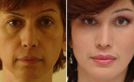 Фото до и после хирургического омоложения лица по результатам анализа