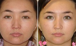 Фото до и после пластики по уменьшению ширины лица