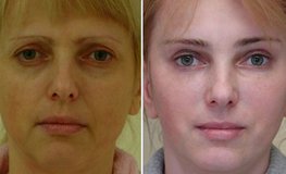 Фото до и после хирургического омоложения лица с предварительным анализом