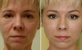 Фото до и после хирургического бъютифицирования лица
