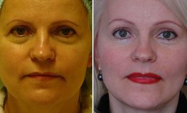 Фото до и после омоложения лица по личной концепции хирурга