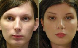 Фото до и после пластики по приданию лицу женственного вида