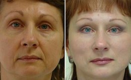 Фото до и после хирургической подтяжки шеи и лица