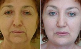 Фото до и после пластики по выраженным возрастным изменениям лица