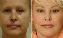 Фото до и после омоложения лица и шеи по личной методике хирурга