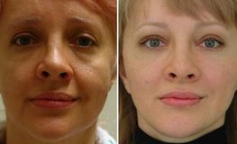 Фото до и после пластики по омоложению ассиметричного лица
