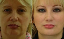 Фото до и после пластики лица и шеи по личной концепции врача