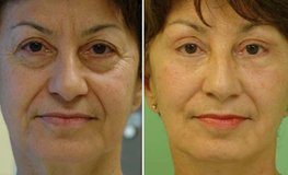 Фото до и после хирургического омоложения лица по личной концепции врача