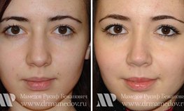 Фото до и после коррекции носа (ринопластики) 
